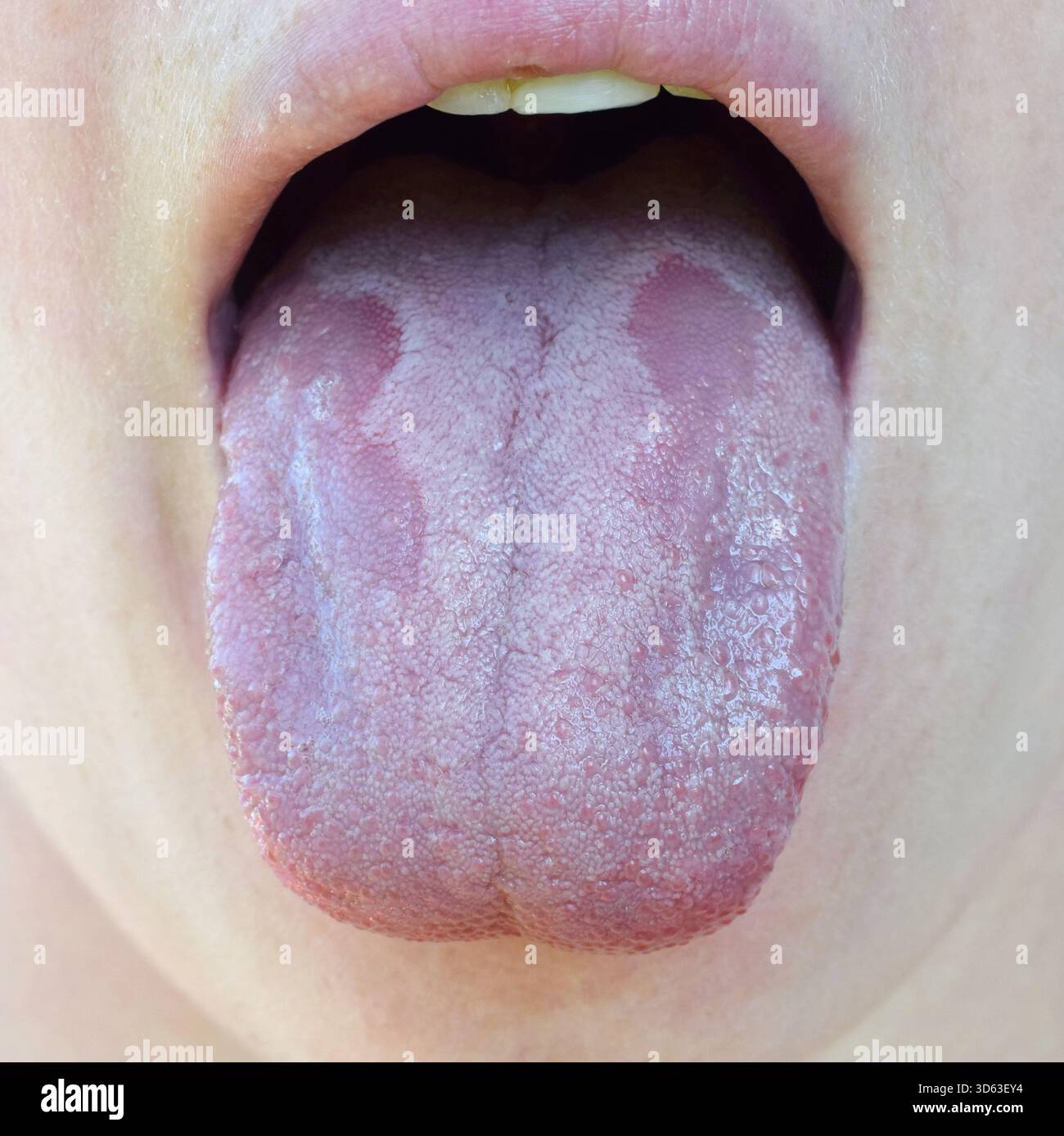 Candidose buccale Banque de photographies et d'images  haute rsolution -  Alamy