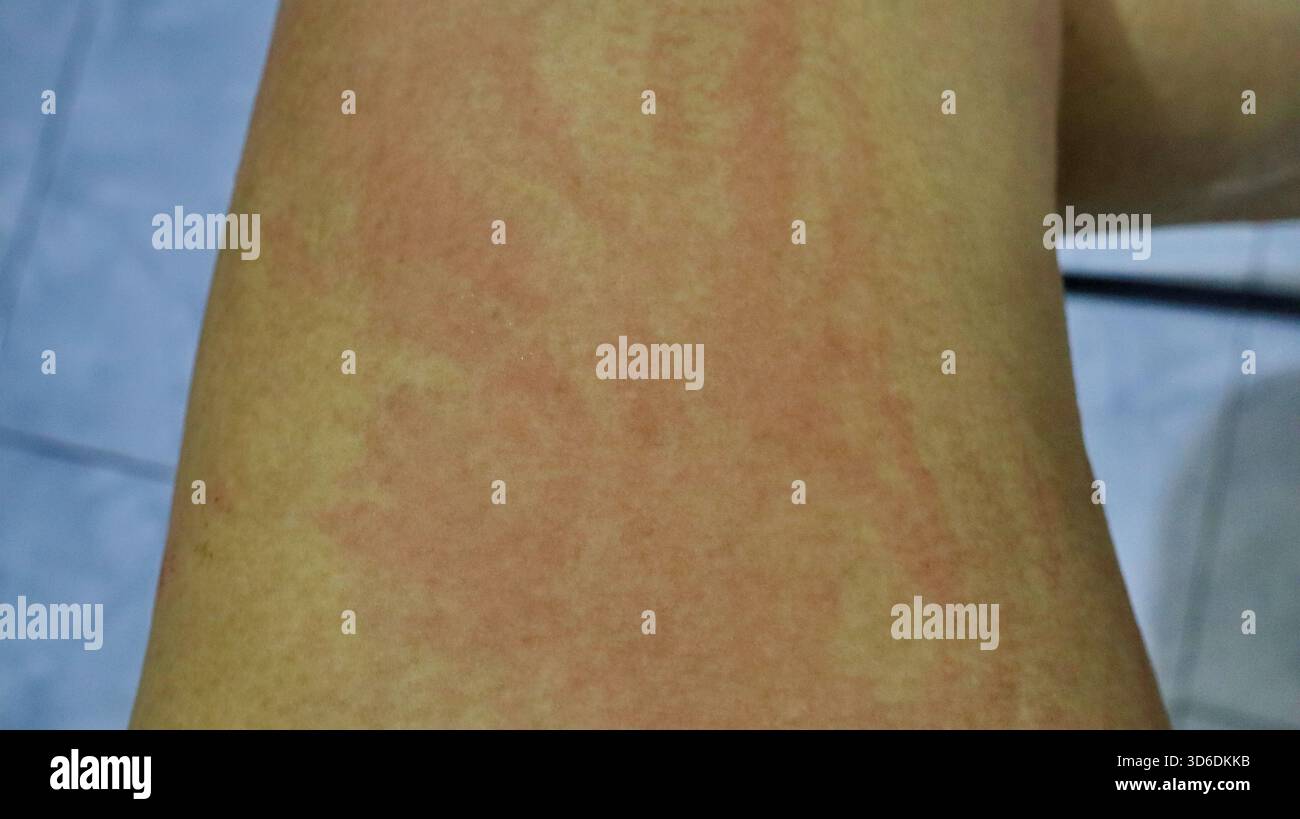 Gros plan détaillé de la peau humaine avec irritation cutanée rouge, allergie possible, eczéma, dermatite ou infection. Concept de santé médicale pour les maladies de la peau, i. Banque D'Images