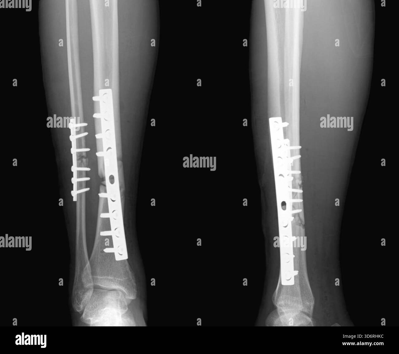 Radiographie de la jambe, montrant une fracture des os du tibia et du péroné qui ont été fixés intérieurement. La fixation stabilise l'os pour maintenir l'alignement et favoriser une cicatrisation correcte. Cette chirurgie est nécessaire dans les cas graves où les os se sont déplacés hors de position. La physiothérapie est utilisée en réadaptation. Banque D'Images