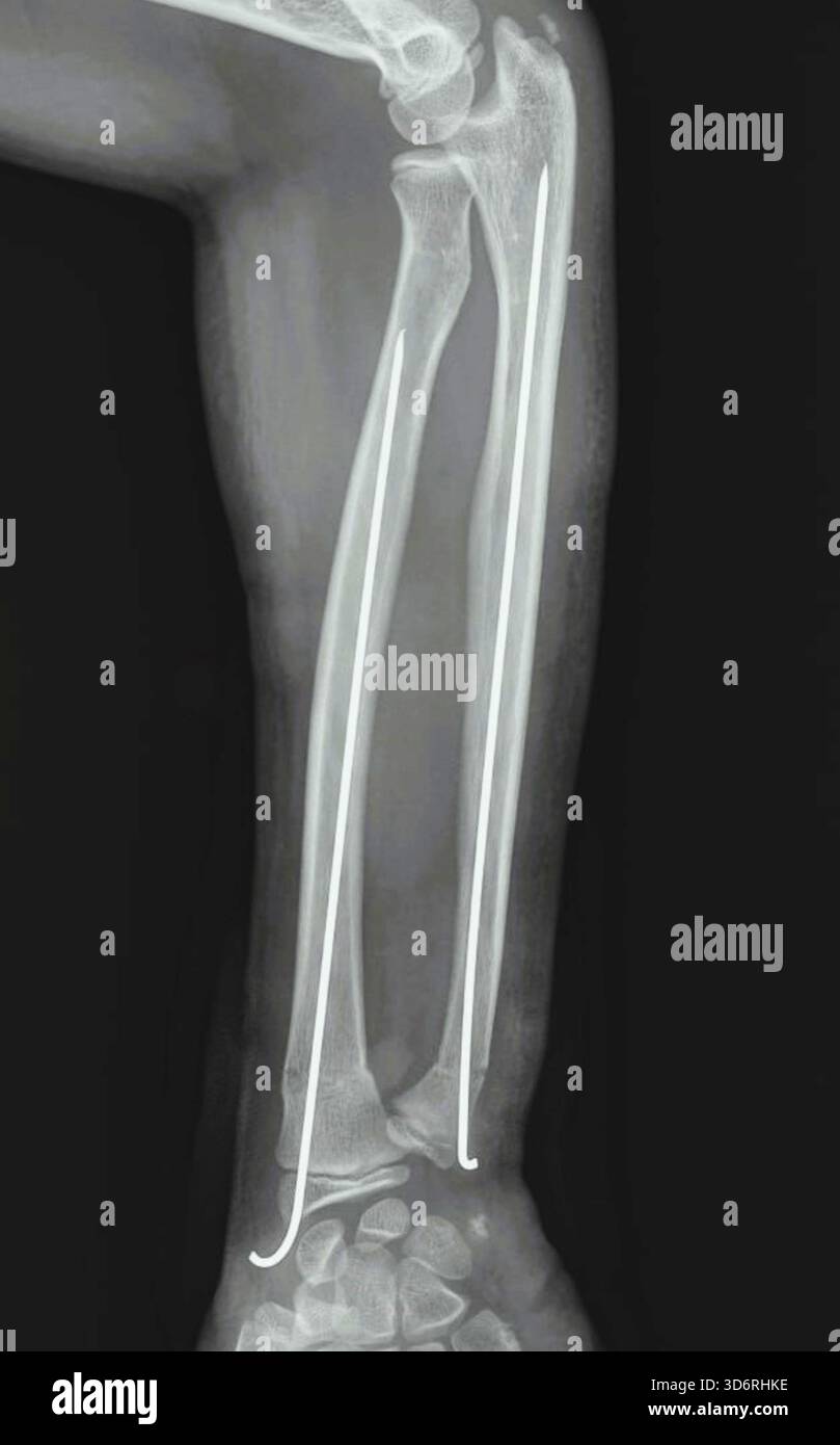 Radiographie de l'avant-bras, montrant une fracture des os du radius et du cubitus qui ont été fixés à l'intérieur. La fixation stabilise l'os pour maintenir l'alignement et favoriser une cicatrisation correcte. Cette chirurgie est nécessaire dans les cas graves où les os se sont déplacés hors de position. Banque D'Images