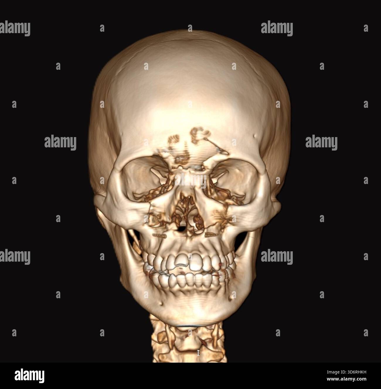 Tomodensitométrie (CT) 3D couleur de la tête d'un patient avec un crâne fracturé. Il y a une fracture dans l'os frontal et la paroi du sinus maxillaire. Banque D'Images