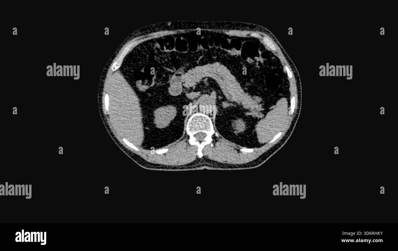 Tomodensitométrie (TDM) d'un pancréas normal. Banque D'Images