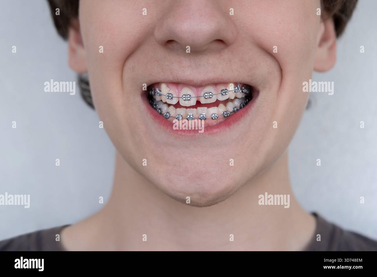 Gros plan d'un jeune souriant avec des appareils dentaires métalliques sur les dents. Traitement orthodontique, soins dentaires et concept de correction de morsure sur un Clean Banque D'Images
