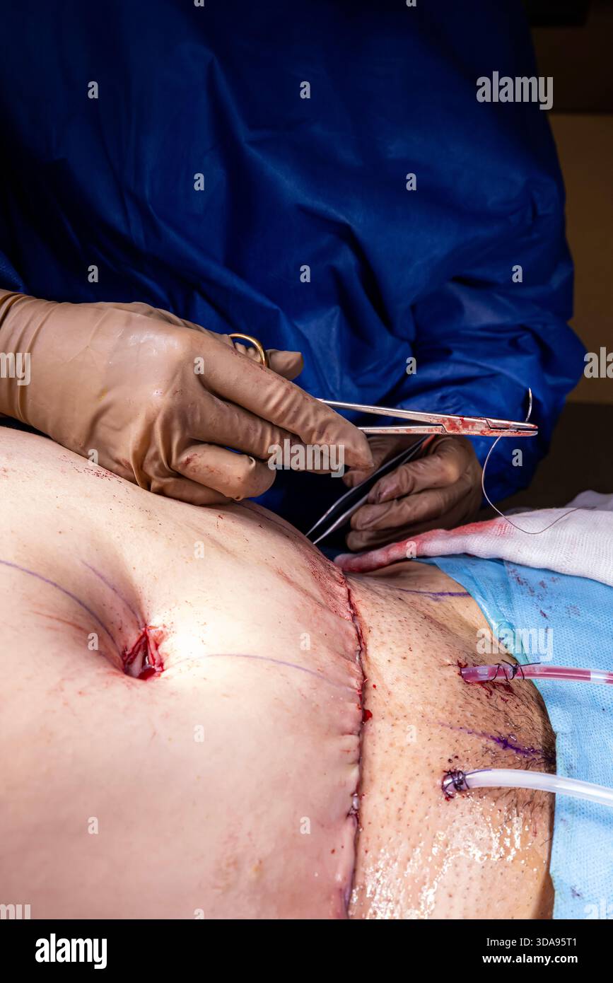 Chirurgien plaçant des points de suture sur l'abdomen du patient pendant la procédure Tummy Tuck dans la salle d'opération moderne, équipe médicale effectuant la chirurgie esthétique sous Ste Banque D'Images