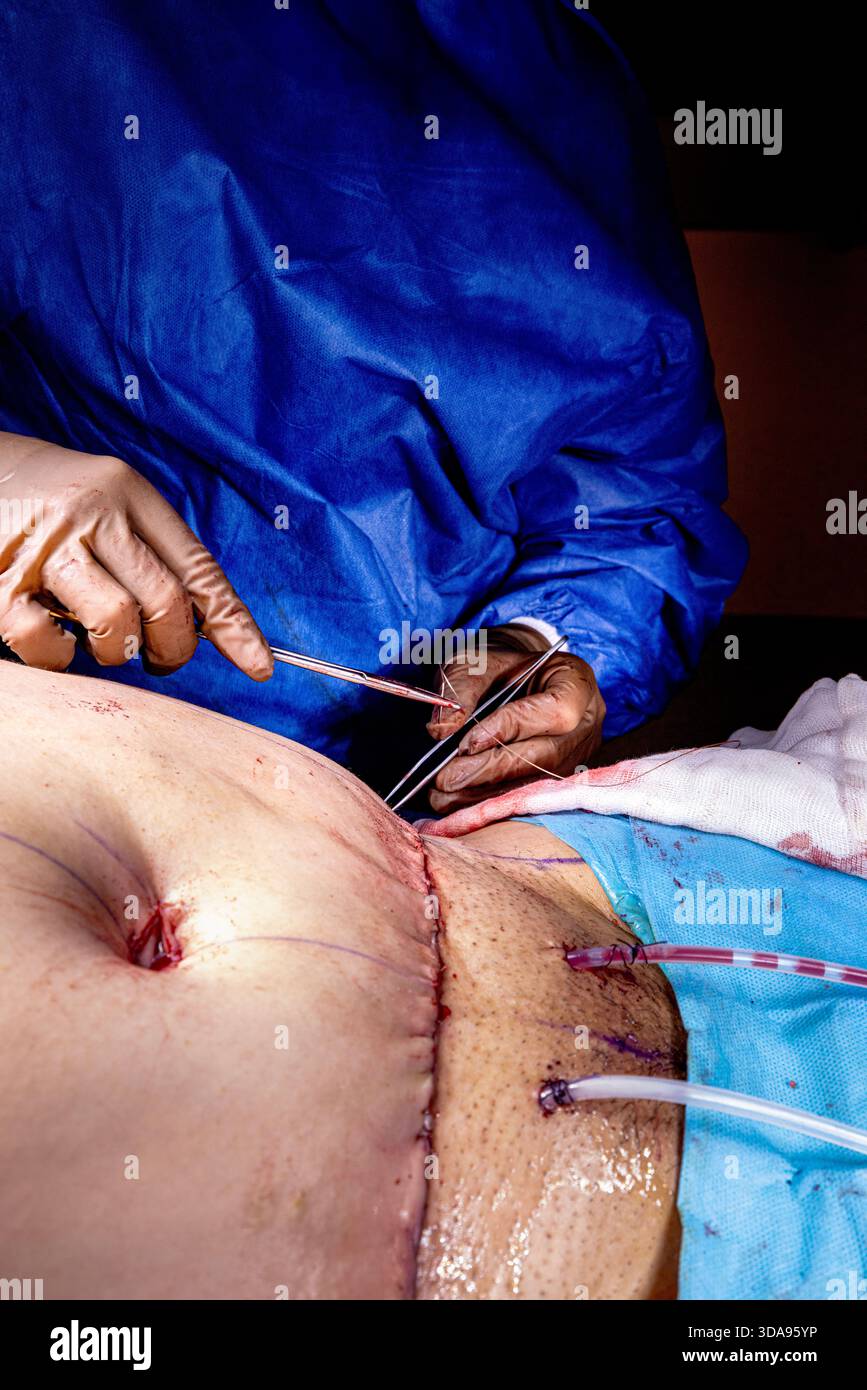 Chirurgien plaçant des points de suture sur l'abdomen du patient pendant la procédure Tummy Tuck dans la salle d'opération moderne, équipe médicale effectuant la chirurgie esthétique sous Ste Banque D'Images