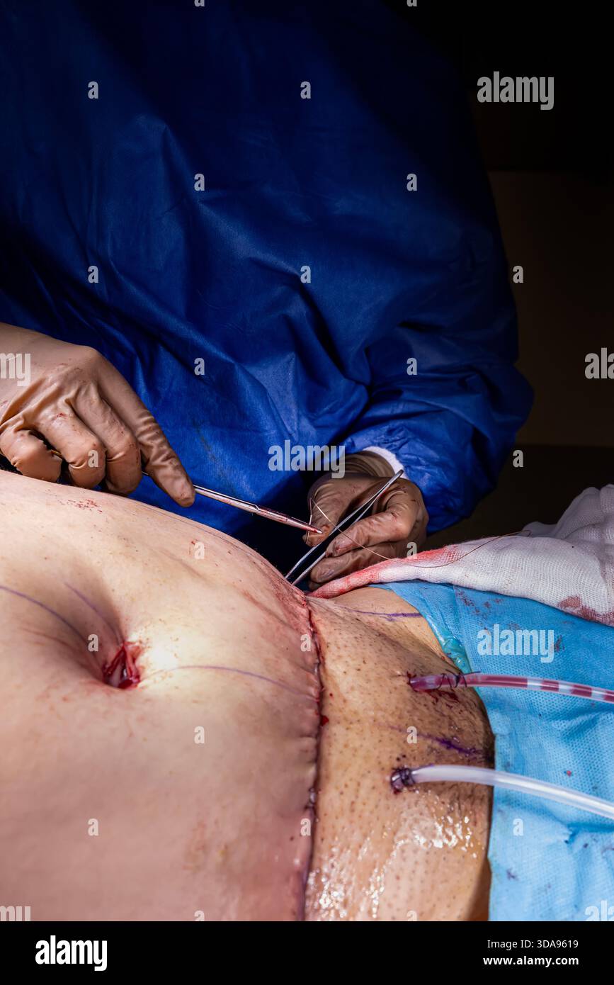Chirurgien plaçant des points de suture sur l'abdomen du patient pendant la procédure Tummy Tuck dans la salle d'opération moderne, équipe médicale effectuant la chirurgie esthétique sous Ste Banque D'Images
