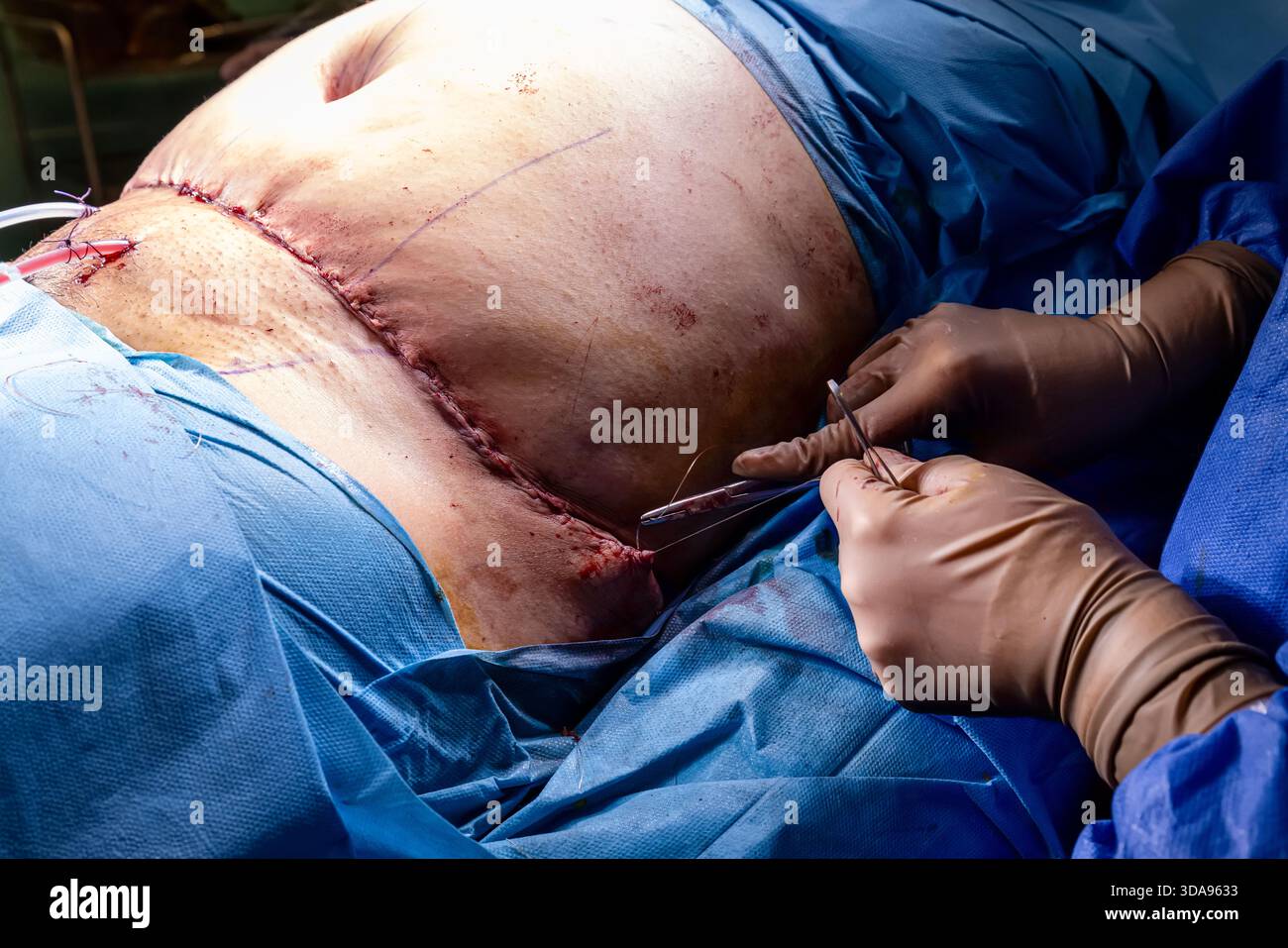 Chirurgien plaçant des points de suture sur l'abdomen du patient pendant la procédure Tummy Tuck dans la salle d'opération moderne, équipe médicale effectuant la chirurgie esthétique sous Ste Banque D'Images