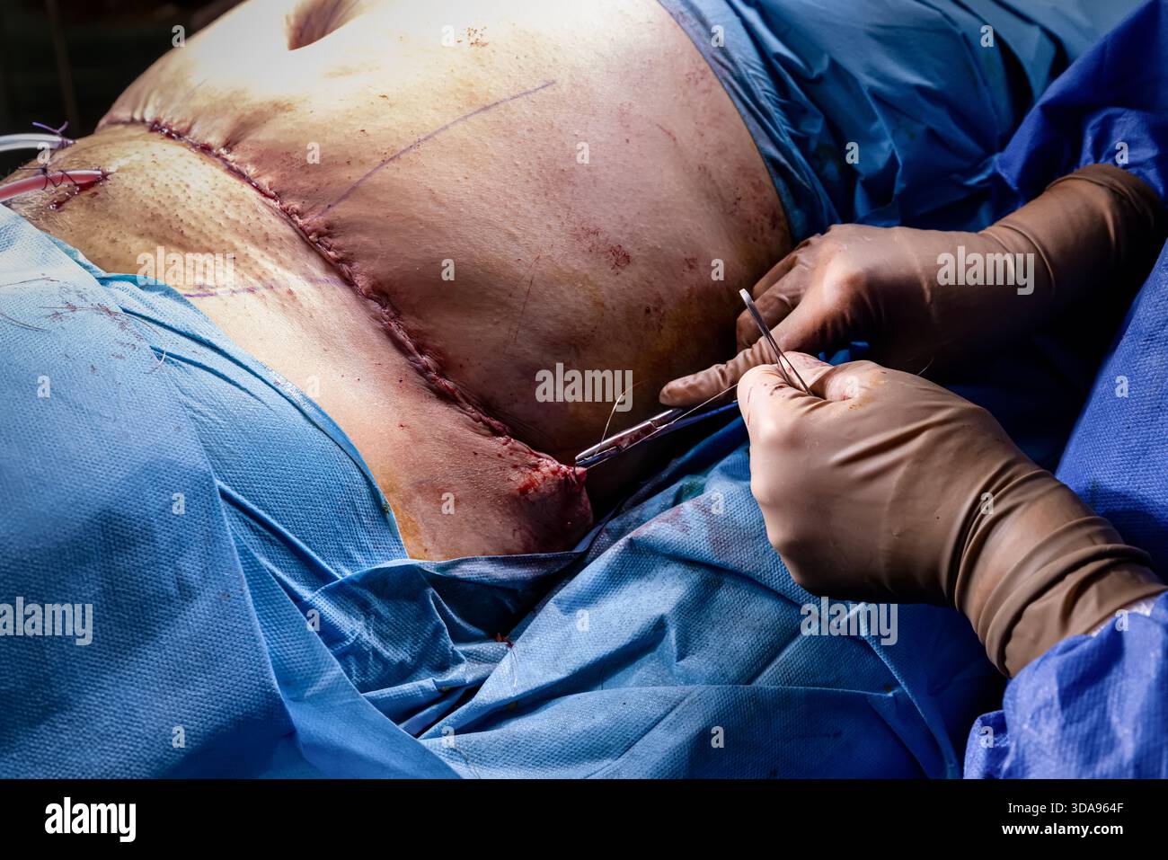 Chirurgien plaçant des points de suture sur l'abdomen du patient pendant la procédure Tummy Tuck dans la salle d'opération moderne, équipe médicale effectuant la chirurgie esthétique sous Ste Banque D'Images