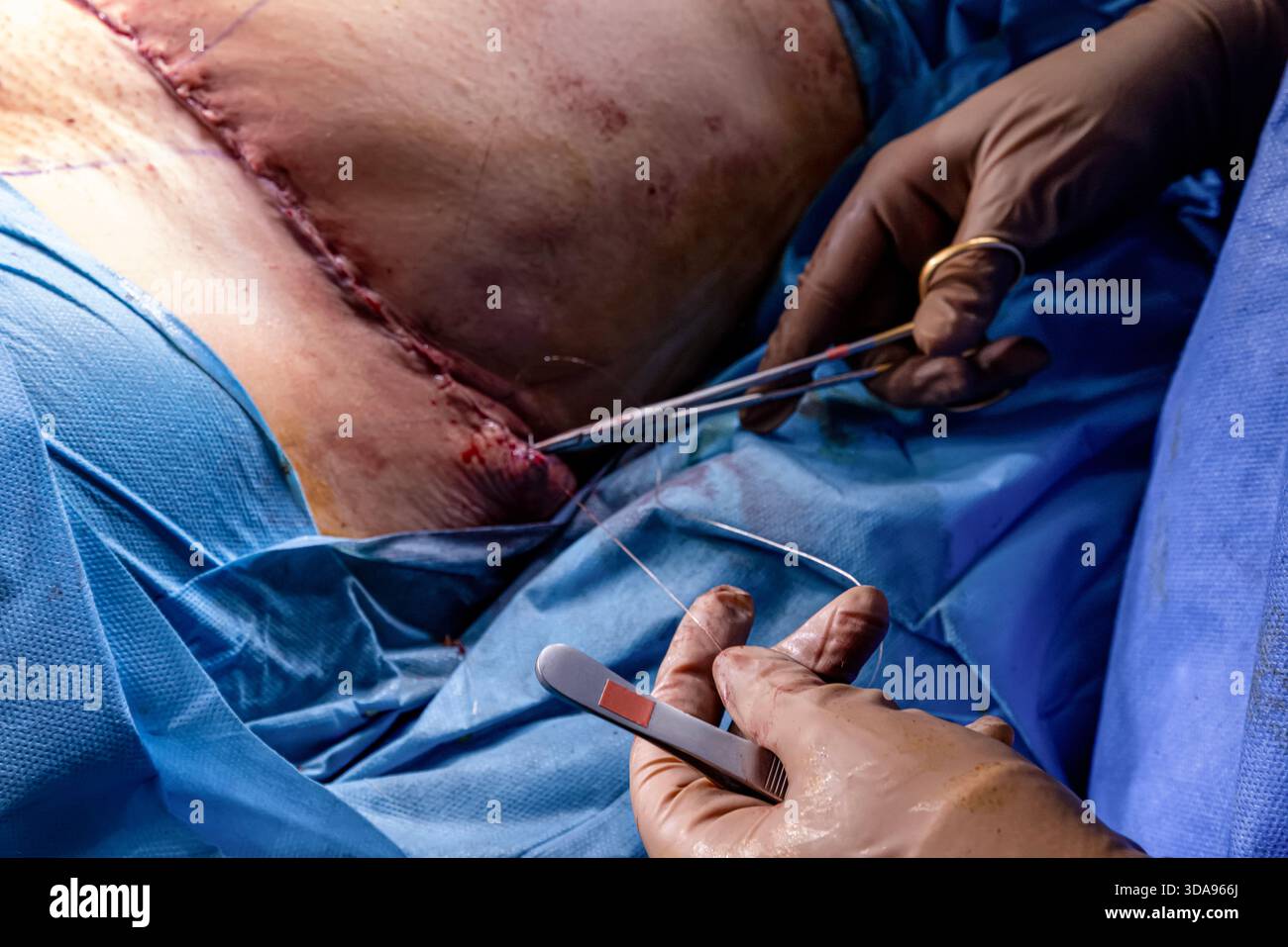 Chirurgien plaçant des points de suture sur l'abdomen du patient pendant la procédure Tummy Tuck dans la salle d'opération moderne, équipe médicale effectuant la chirurgie esthétique sous Ste Banque D'Images
