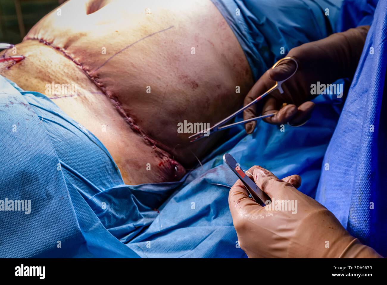 Chirurgien plaçant des points de suture sur l'abdomen du patient pendant la procédure Tummy Tuck dans la salle d'opération moderne, équipe médicale effectuant la chirurgie esthétique sous Ste Banque D'Images