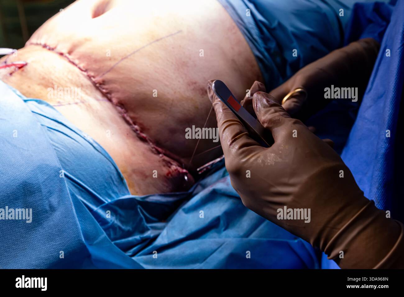 Chirurgien plaçant des points de suture sur l'abdomen du patient pendant la procédure Tummy Tuck dans la salle d'opération moderne, équipe médicale effectuant la chirurgie esthétique sous Ste Banque D'Images