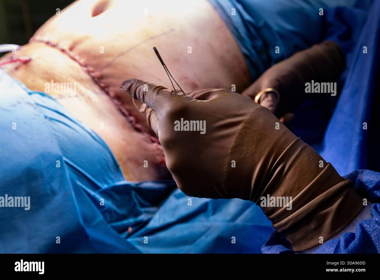 Chirurgien plaçant des points de suture sur l'abdomen du patient pendant la procédure Tummy Tuck dans la salle d'opération moderne, équipe médicale effectuant la chirurgie esthétique sous Ste Banque D'Images