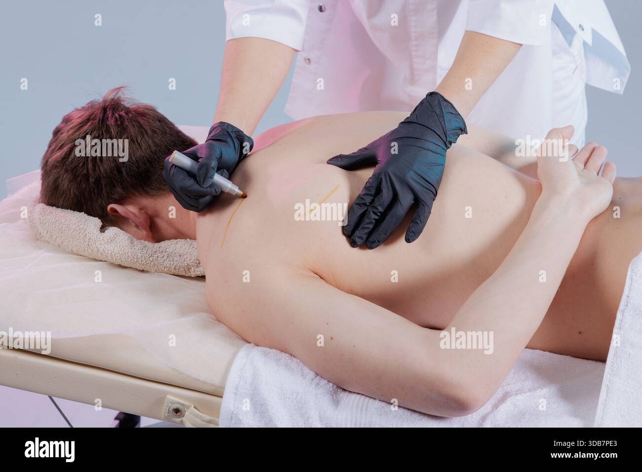 Un thérapeute marque les points de déclenchement sur le dos d'un homme avec un marqueur avant une séance de thérapie myofasciale de points de déclenchement, de dessiccation et d'acupuncture Banque D'Images