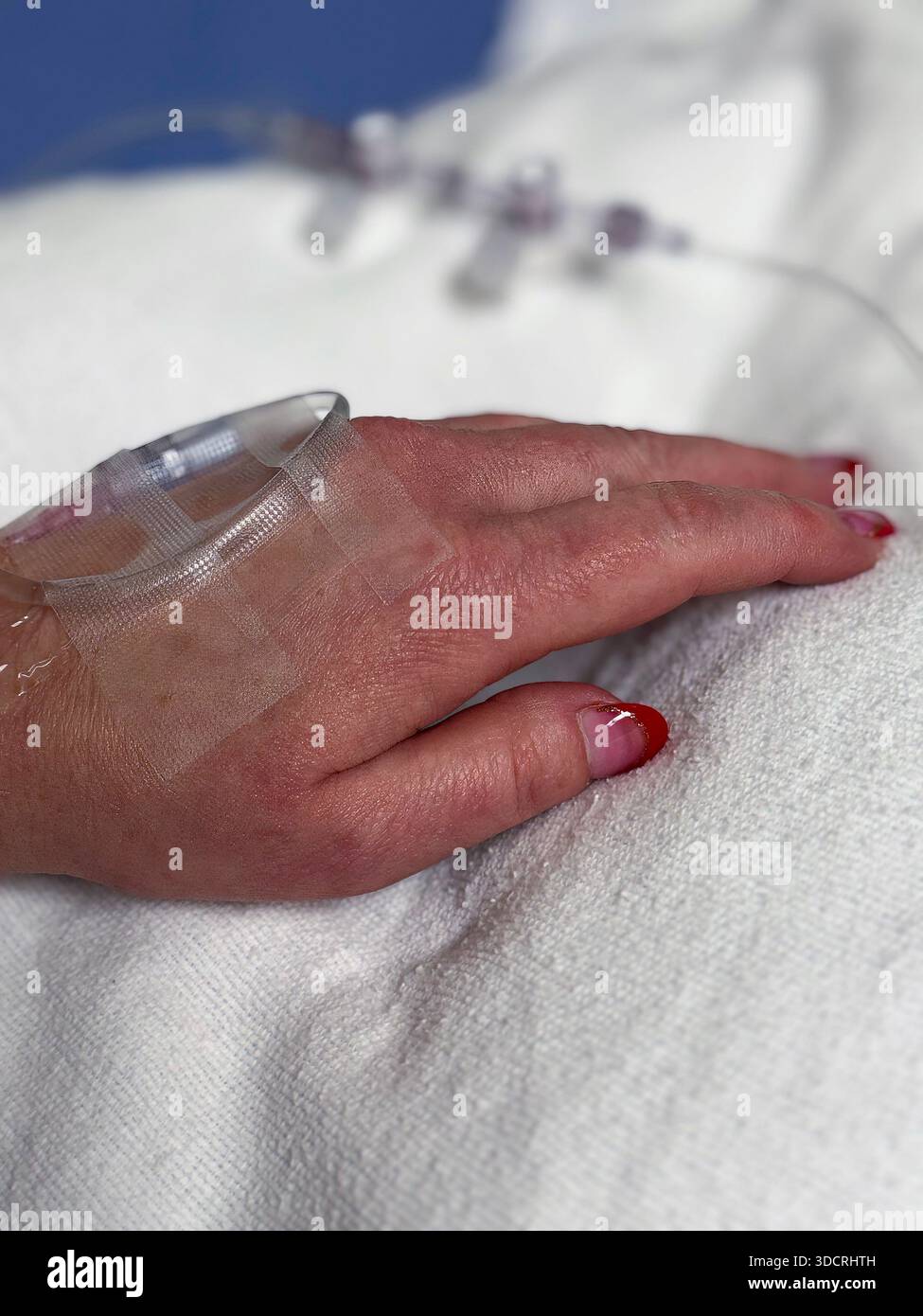 Gros plan d’un implant IV fixé à la main d’un patient, à la tubulure et au cathéter en place, reflétant une anticipation silencieuse avant la chirurgie dans un ensemble médical calme Banque D'Images