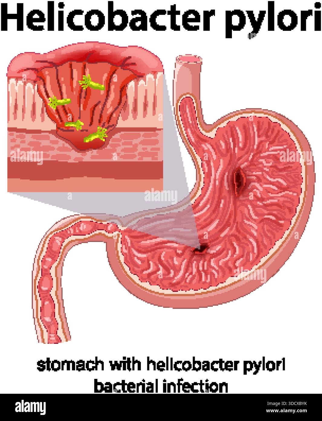 Illustration vectorielle médicale de l'estomac avec infection à Helicobacter pylori, coupe transversale détaillée, étiquetée Illustration de Vecteur