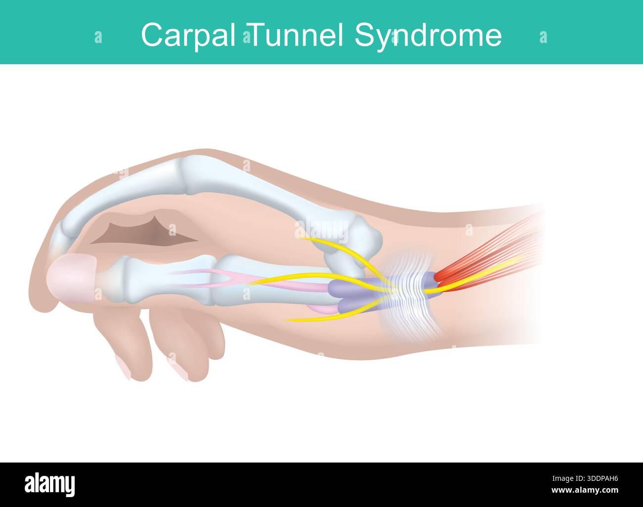 Ce diagramme illustre le syndrome du canal carpien, montrant le nerf médian (jaune) traversant le canal carpien au poignet. Inflammation ou swe Illustration de Vecteur