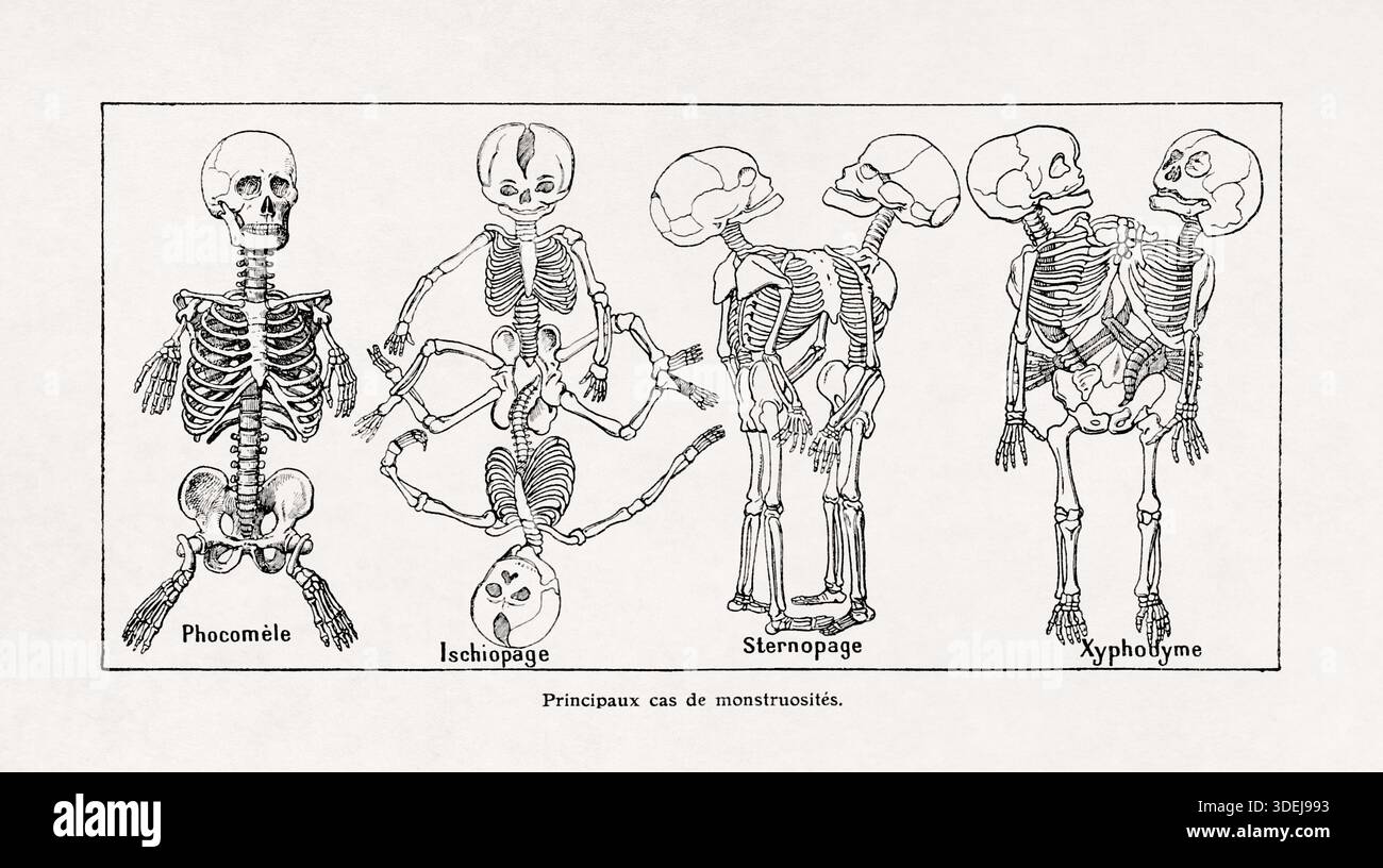Illustration d'anomalies du squelette humain (phocomélie, Ischiopagi, thoracopage et xiphopage) d'un ancien dictionnaire français. Banque D'Images