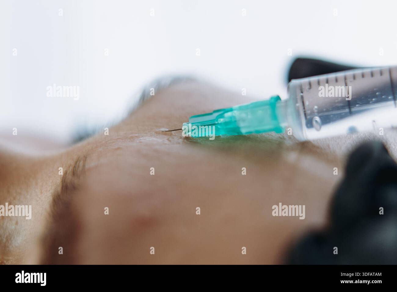 gros plan des mains professionnelles faisant une injection de rajeunissement dans la ligne sournoise de la femme Banque D'Images