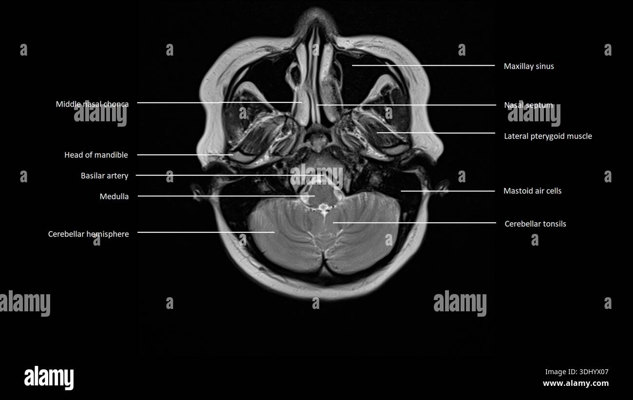 Imagerie par résonance magnétique (IRM) marquée d'une coupe axiale d'un cerveau normal. Banque D'Images
