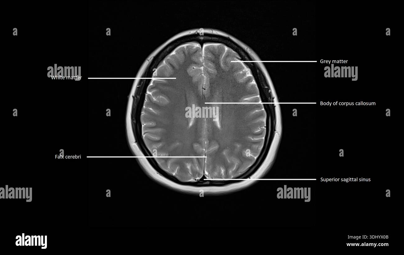 Imagerie par résonance magnétique (IRM) marquée d'une coupe axiale d'un cerveau normal. Banque D'Images