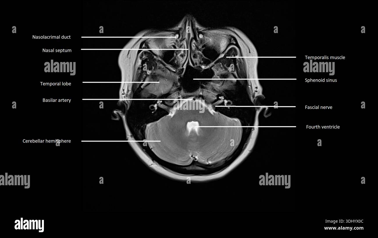 Imagerie par résonance magnétique (IRM) marquée d'une coupe axiale d'un cerveau normal. Banque D'Images