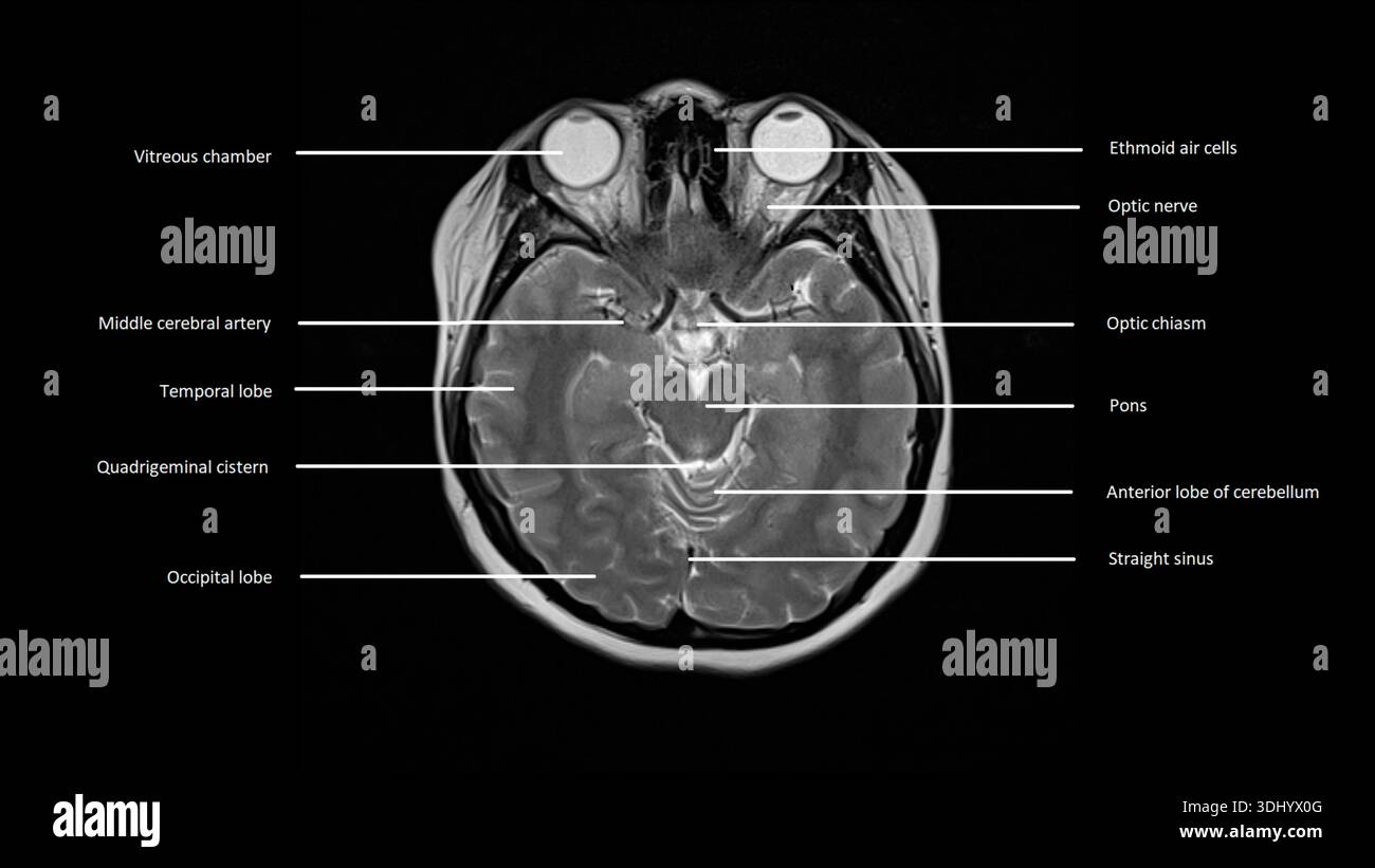 Imagerie par résonance magnétique (IRM) marquée d'une coupe axiale d'un cerveau normal. Banque D'Images