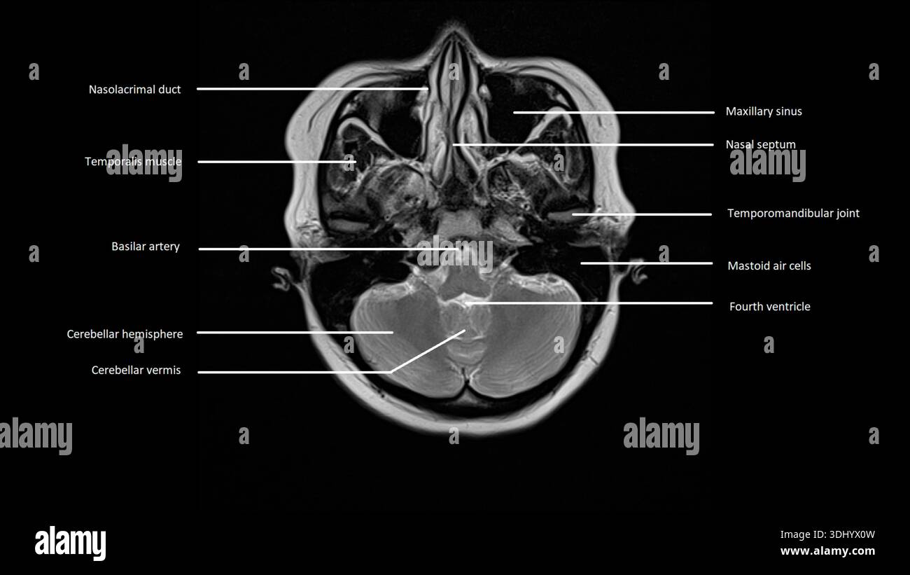 Imagerie par résonance magnétique (IRM) marquée d'une coupe axiale d'un cerveau normal. Banque D'Images