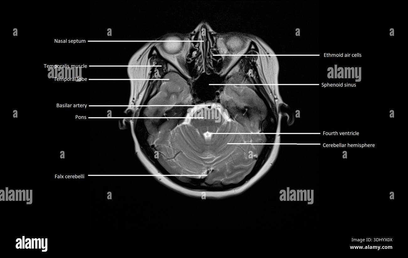 Imagerie par résonance magnétique (IRM) marquée d'une coupe axiale d'un cerveau normal. Banque D'Images