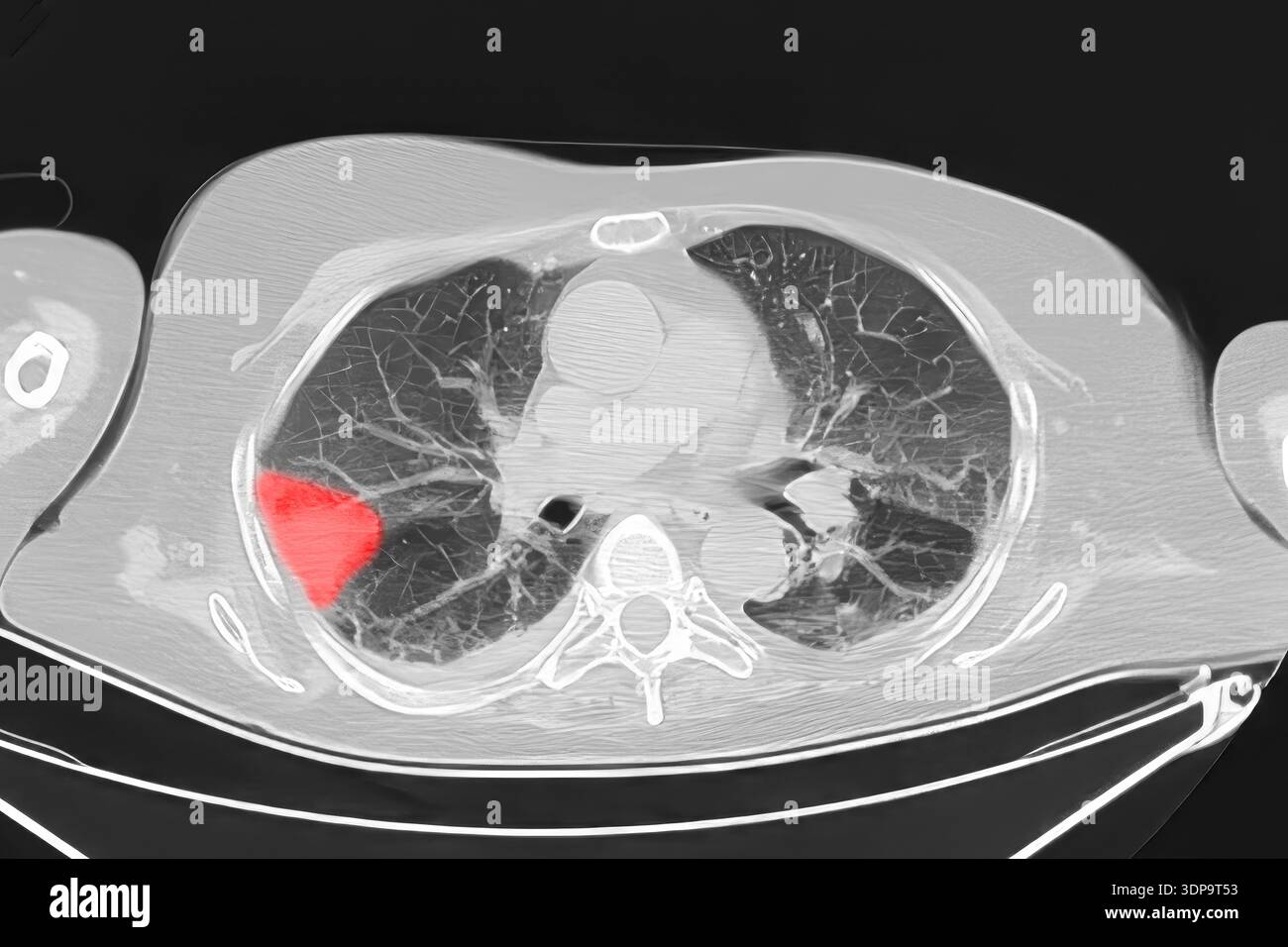 Infarctus Rouge Hypoxie pulmonaire Banque de photographies et d’images à haute ...