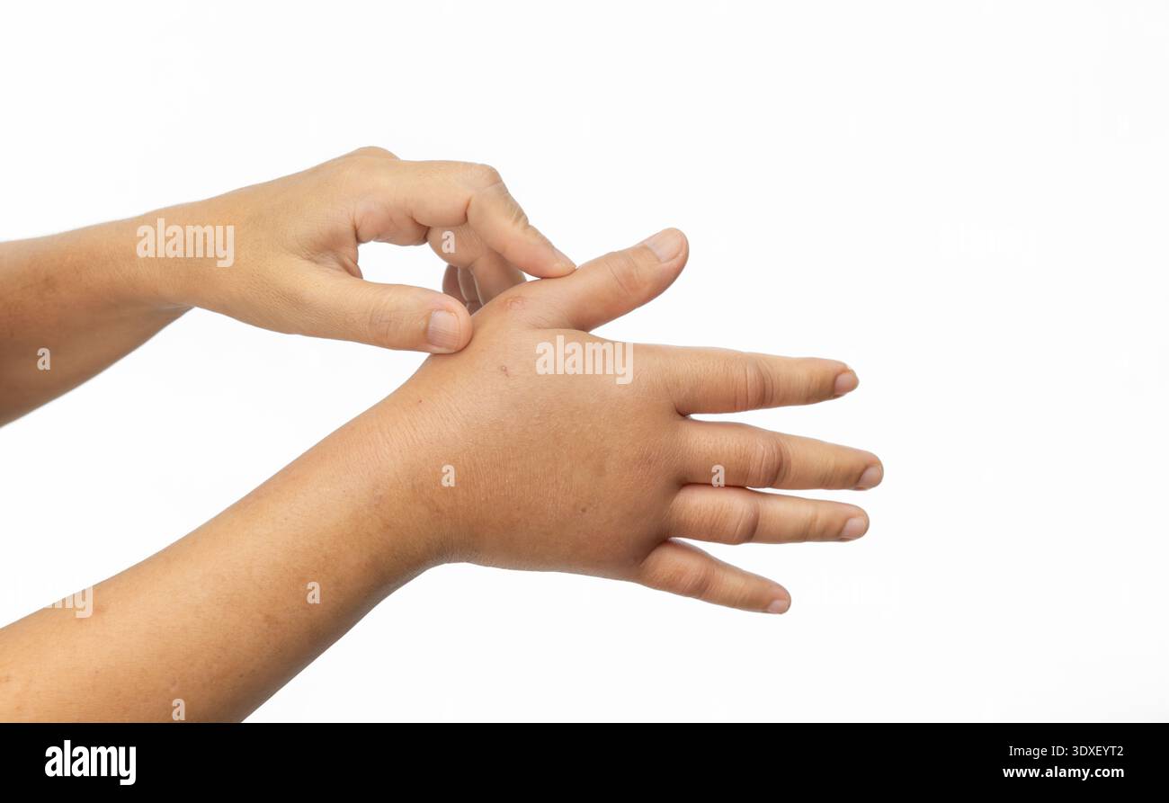 Main gonflée d'une allergie aux piqûres d'insectes. Soins allergiques à la peau. Banque D'Images