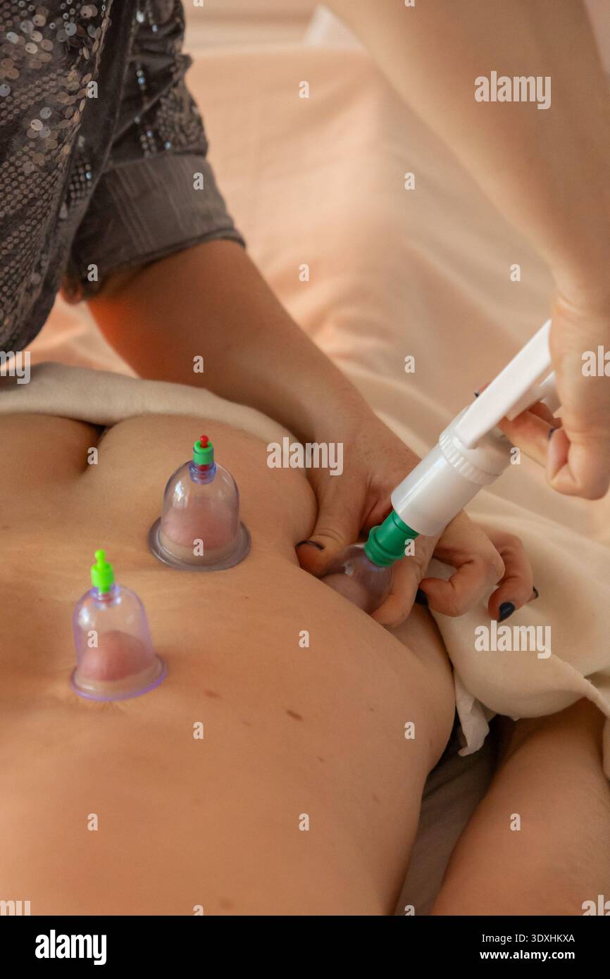 La thérapie par ventouse, Une pratique de guérison traditionnelle. Une femme effectuant la thérapie de ventouse sur un dos de personne avec des ventouses en utilisant la méthode de l'acupuncture Banque D'Images