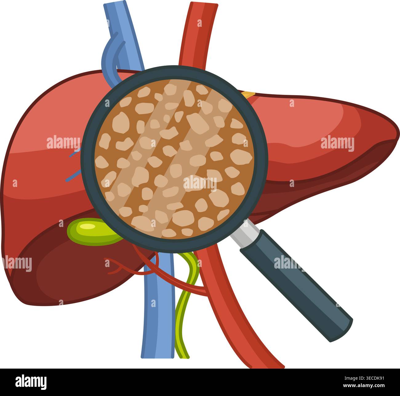 Maladie du foie. Cirrhose du foie sous loupe. Illustration vectorielle d'organes humains. Anatomie et médecine Illustration de Vecteur