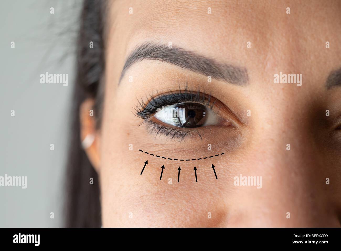 Oeil de femme montrant des cernes et des sacs sous les yeux marqués avec une ligne pointillée et des flèches pour le traitement cosmétique Banque D'Images