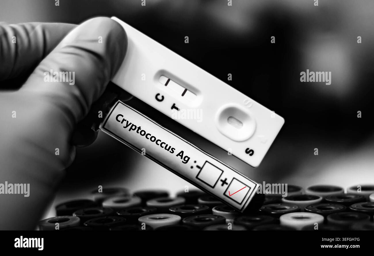 Échantillon sanguin du patient ayant donné un résultat positif pour Cryptococcus AG. Banque D'Images