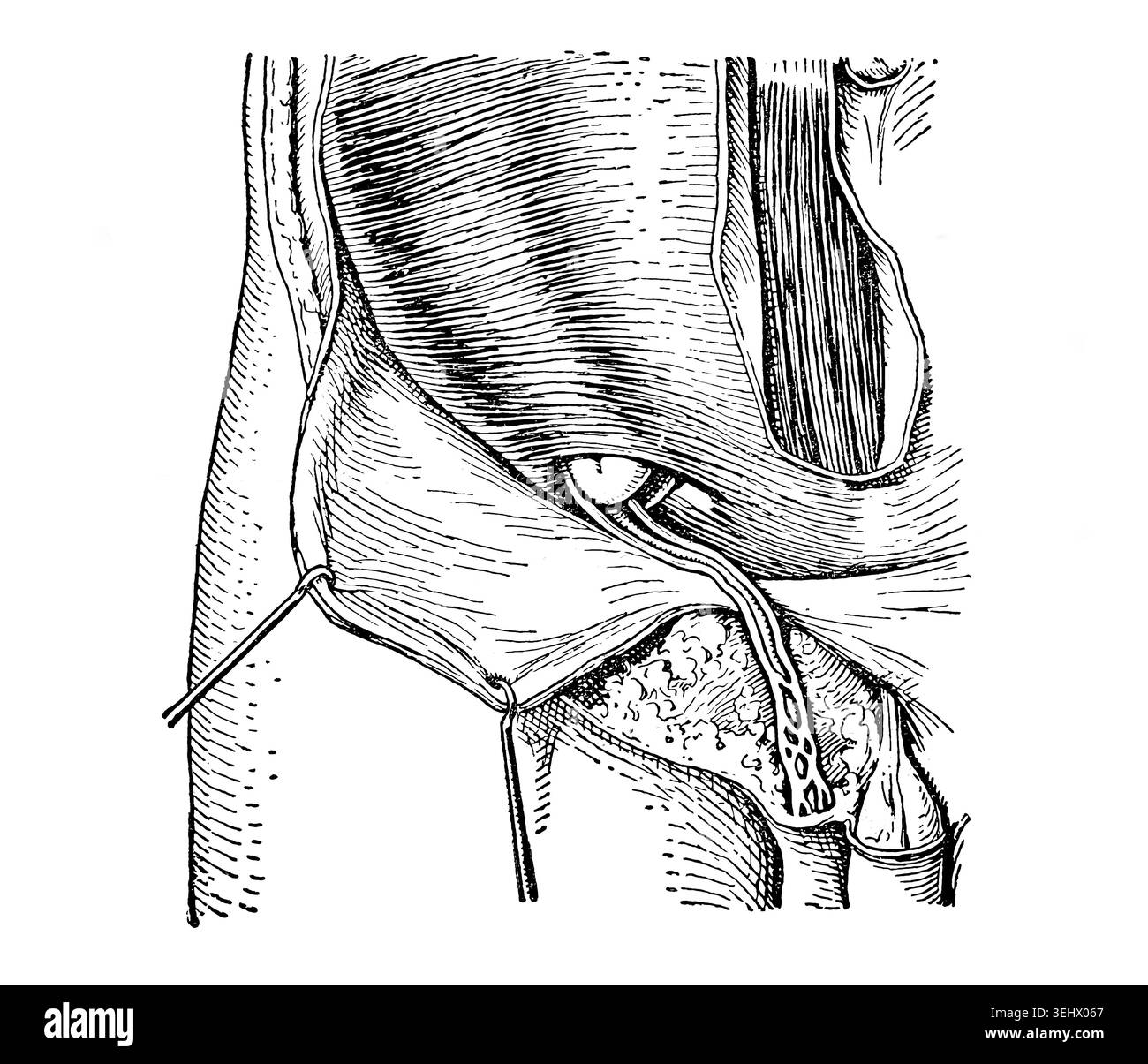 Illustration anatomique antique détaillant la formation précoce et l'anatomie d'une hernie inguinale (rupture) dans la région de l'aine. Gravure sur bois authentique d'un Banque D'Images