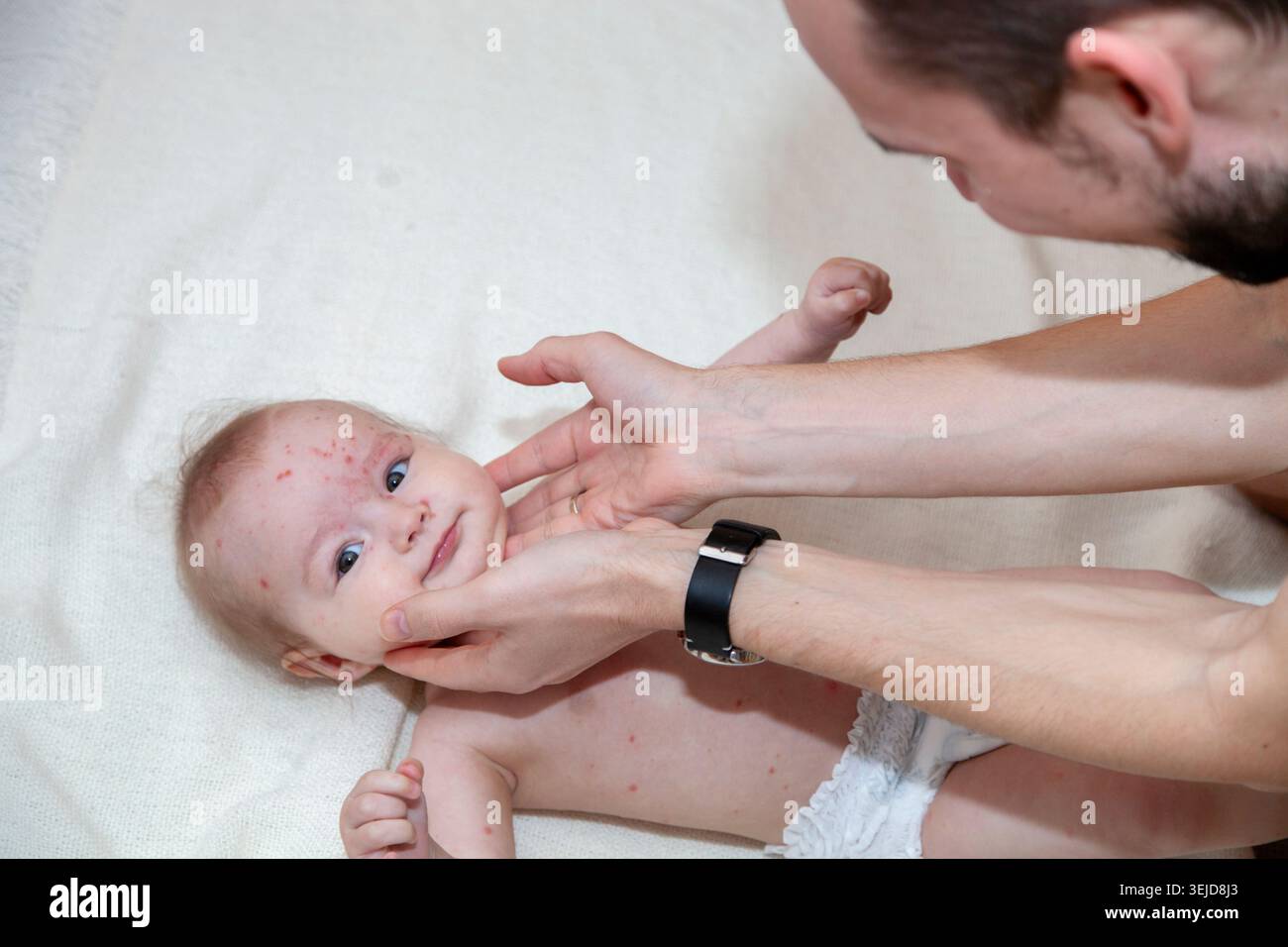 Père prenant soin d'un bébé atteint de varicelle et tenant sa tête Banque D'Images