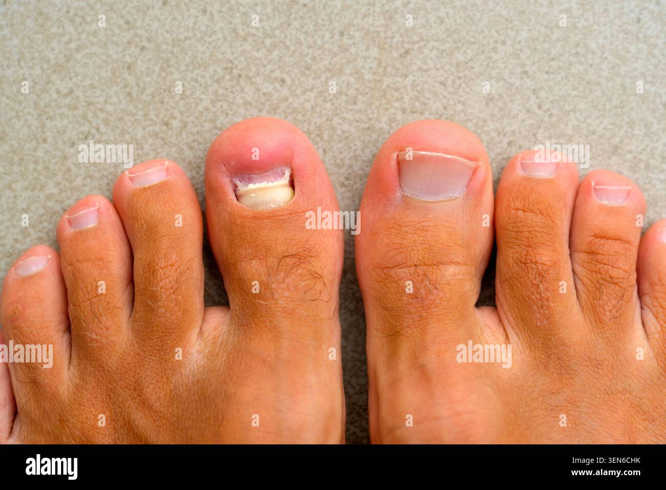 Des ongles et des orteils sains, et à gauche, le blessé a enlevé l'ongle sur le gros petit doigt. Enlevé le vieux clou tombé gros ongle orteil après mécanique Banque D'Images