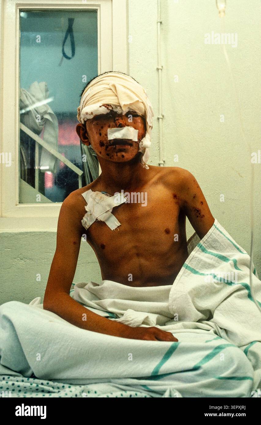 Hôpital du CICR, Kaboul (Afghanistan), août 1992 ; amputés en phase de rétablissement post-opératoire. Après 14 ans de guerre, le comté est un champ de mines, avec plus de 56 000 amputés. Banque D'Images