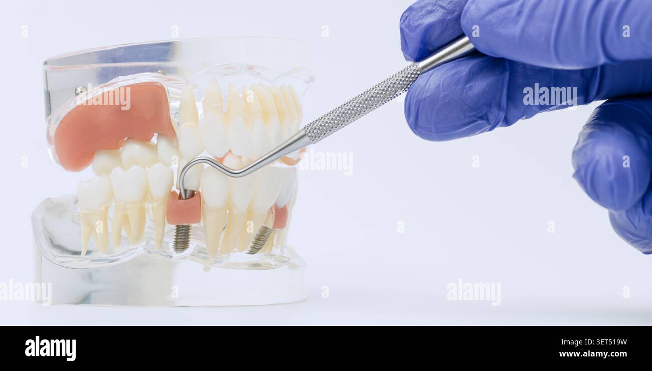 Examen clinique de la restauration d'implant à la main gantée Banque D'Images