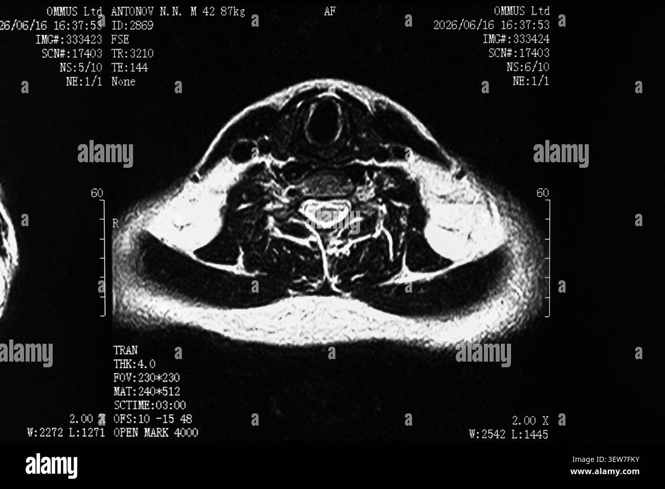 Radiographie IRM du cou et du rachis cervical Banque D'Images