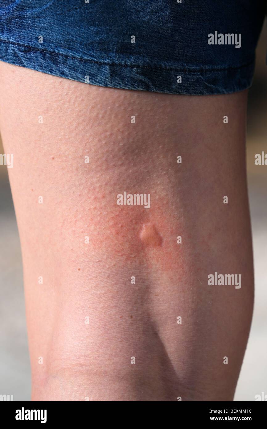 Morsure de moustique peau irritée sur la jambe de la femme (cuisse). Banque D'Images