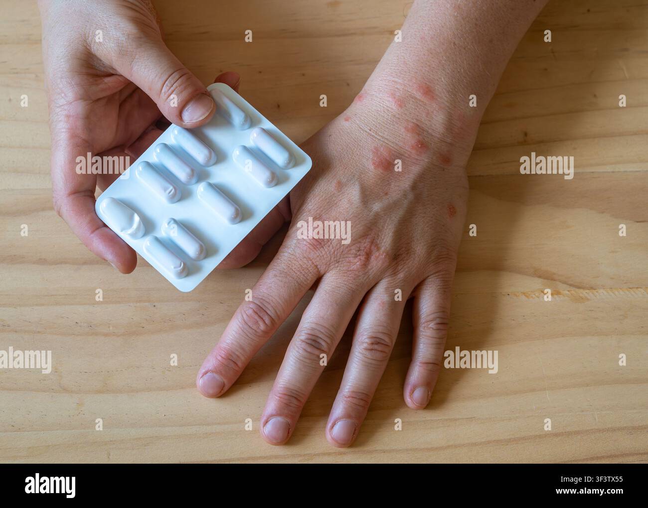 Eczéma de la main infecté avec antibiotiques prescrits pour le traitement des infections cutanées bactériennes Banque D'Images