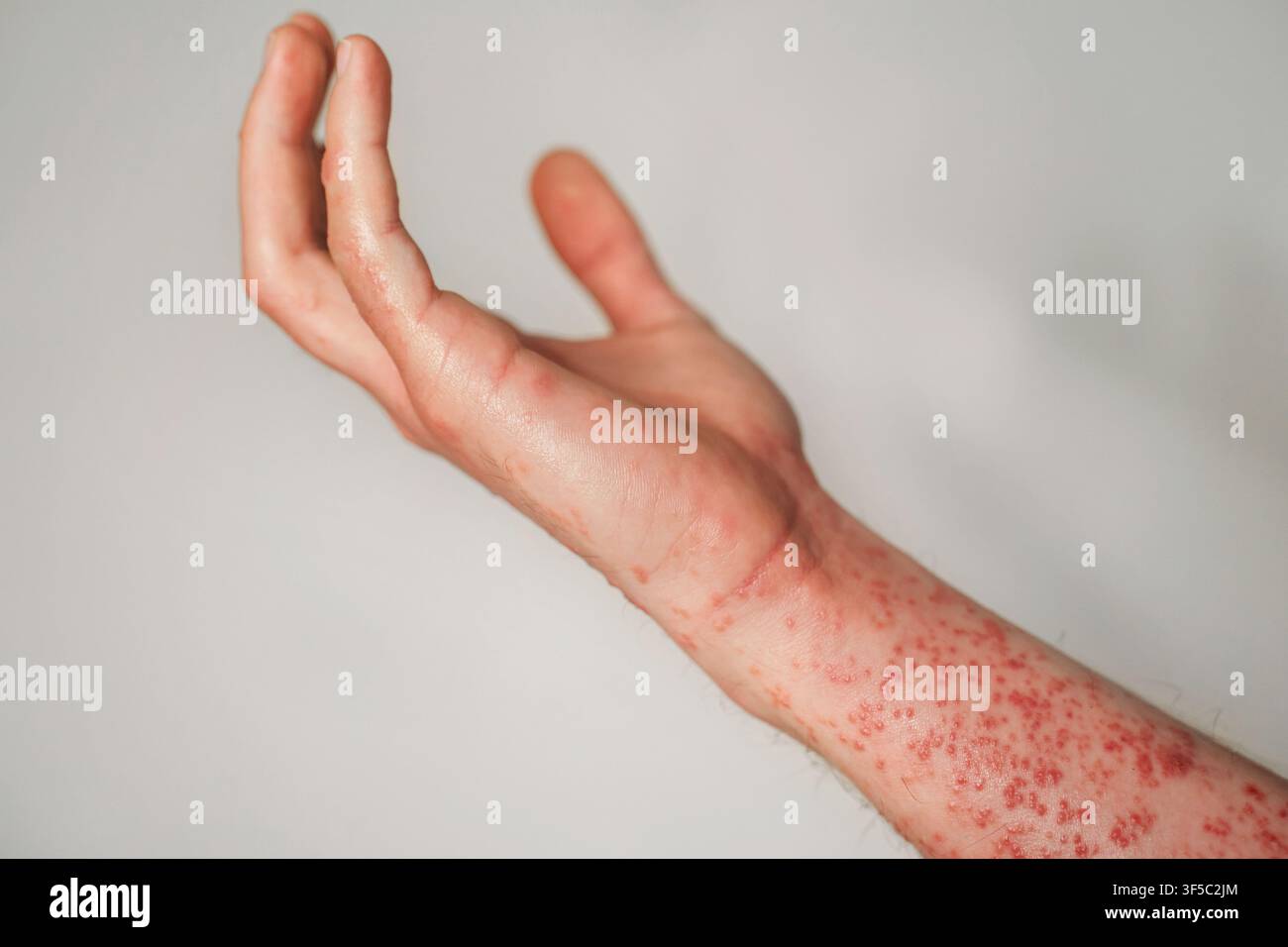 Grossissement d'un bras humain montrant une éruption cutanée sévère avec des boutons rouges et une irritation. Le zona ou l'infection par le virus de l'herpes zôtaire, une affection dermatologique douloureuse, symptômes d'une maladie virale Banque D'Images