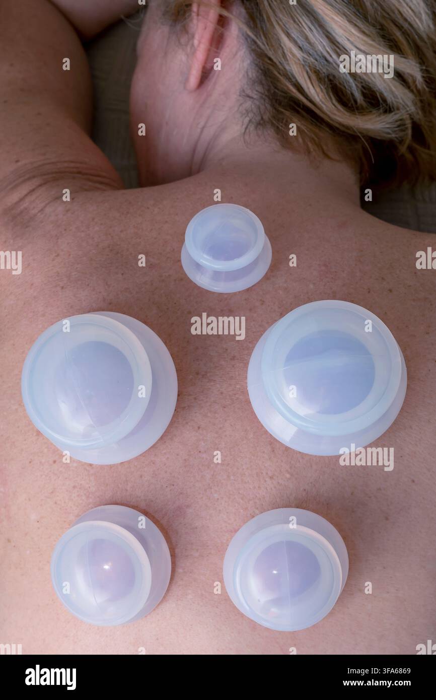 Une femme blonde se couche avec des ventouses en silicone sur le dos pour la technique thérapeutique de cupping Banque D'Images