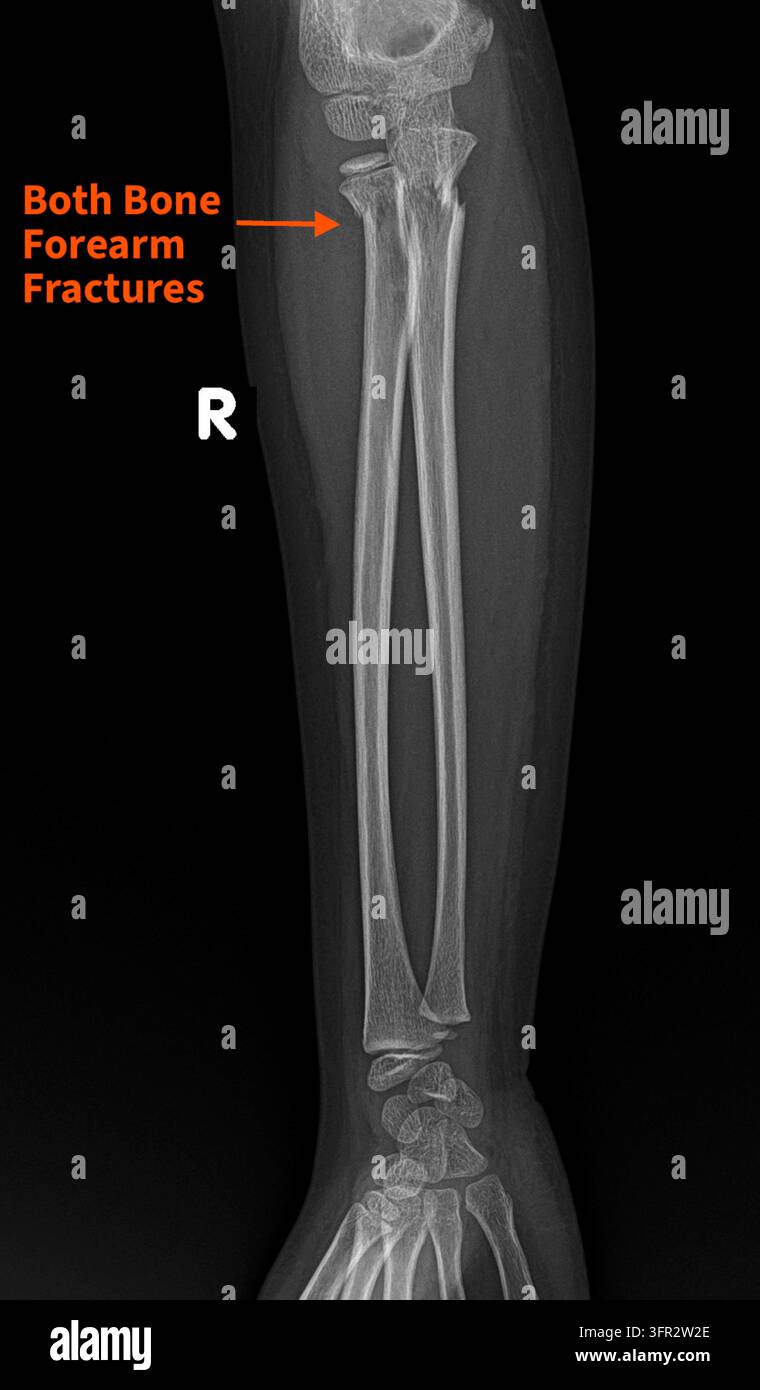 Radiographie de l’avant-bras montrant une fracture à la fois du radius et de l’ulna (les deux os longs de l’avant-bras), appelée fracture des deux os de l’avant-bras. Ce type de traumatisme orthopédique grave nécessite souvent une intervention chirurgicale telle qu’une réduction ouverte et une fixation interne pour rétablir le fonctionnement et la rotation normaux. Banque D'Images