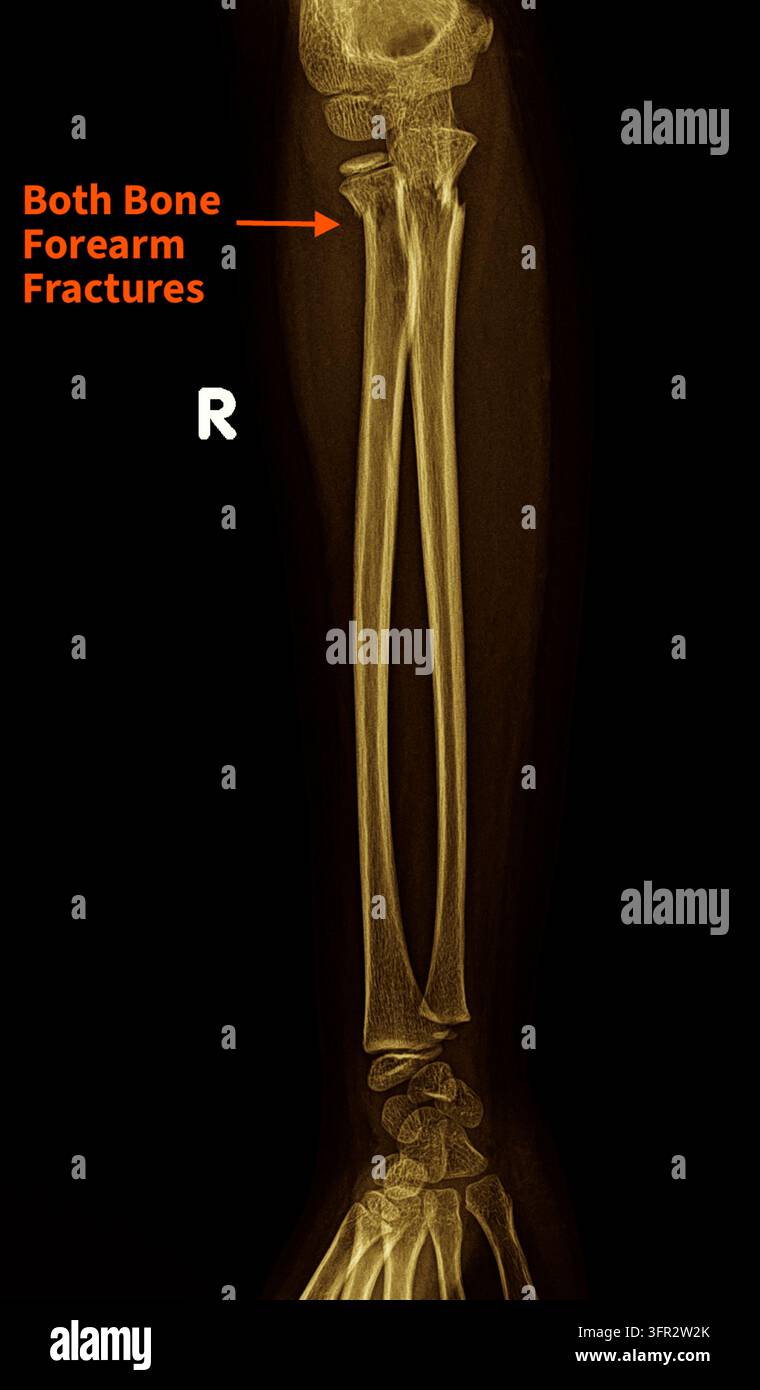 Radiographie de l’avant-bras montrant une fracture à la fois du radius et de l’ulna (les deux os longs de l’avant-bras), appelée fracture des deux os de l’avant-bras. Ce type de traumatisme orthopédique grave nécessite souvent une intervention chirurgicale telle qu’une réduction ouverte et une fixation interne pour rétablir le fonctionnement et la rotation normaux. Banque D'Images