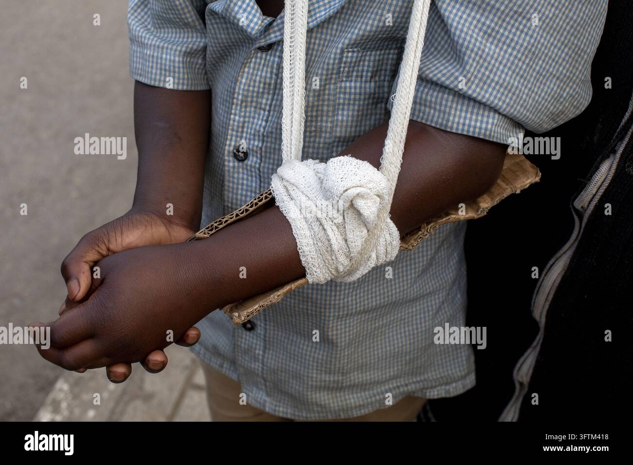 Au Rwanda, un enfant porte une attelle de carton de fortune maintenue en place par des bandages enroulés autour de son bras. Banque D'Images