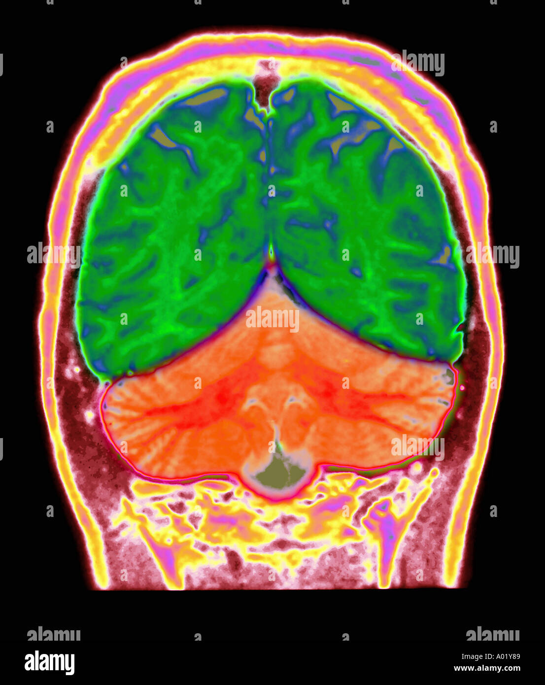 Irm du cerveau 23 ans femme montrant des sillons corticaux cérébraux plus grande que prévu pour l'âge du patient Banque D'Images