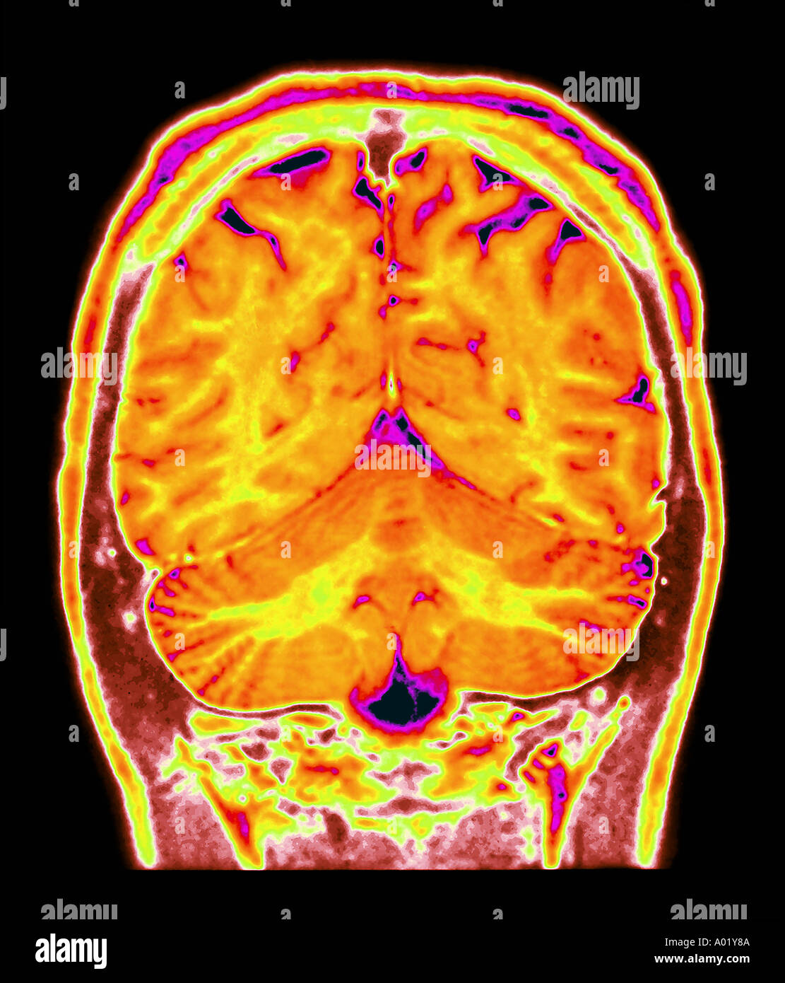 Des sillons corticaux cérébraux plus grande que prévu pour le jeune âge du patient Banque D'Images