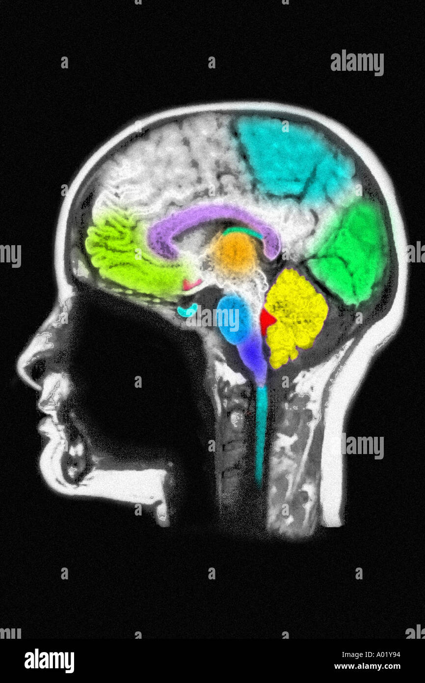 Irm du cerveau montrant l'anatomie normale Banque D'Images